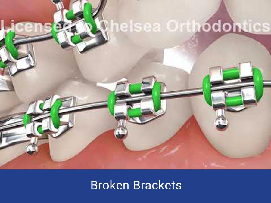 Broken Brackets Chelsea Orthodontics