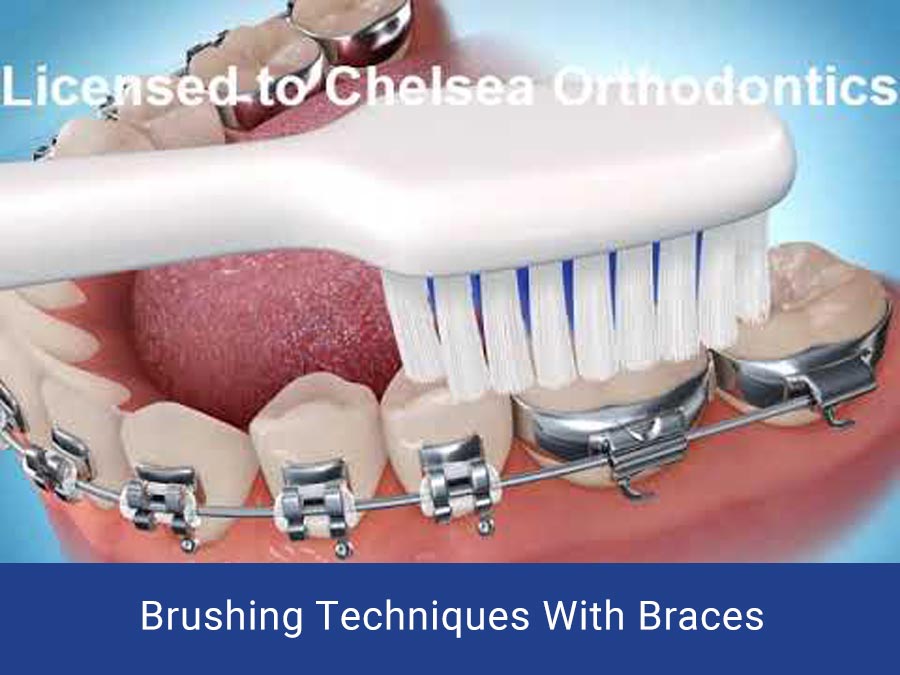 Brushing Techniques With Braces Chelsea Orthodontics