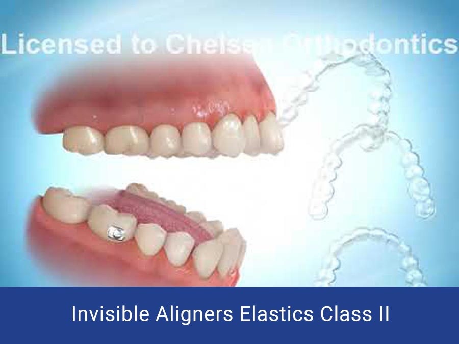 Invisible Aligners Elastics Class II Chelsea Orthodontics