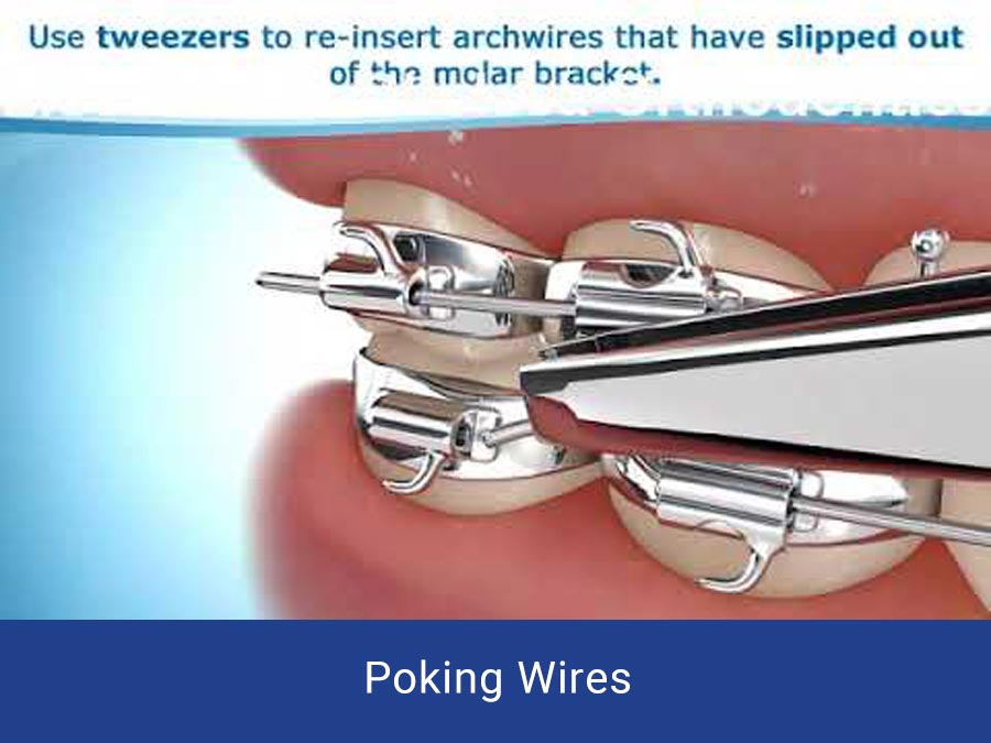 Poking Wires Chelsea Orthodontics