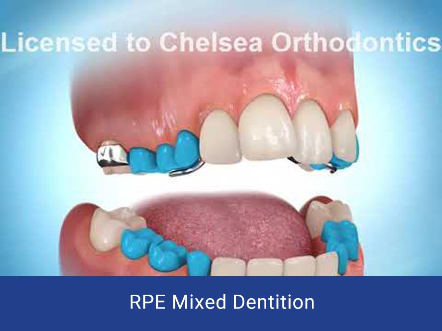 RPE Mixed Dentition Chelsea Orthodontics